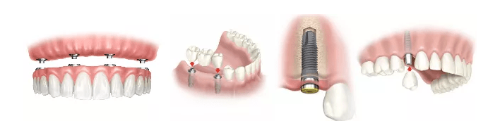 Implantes dentales en Palma de Mallorca
