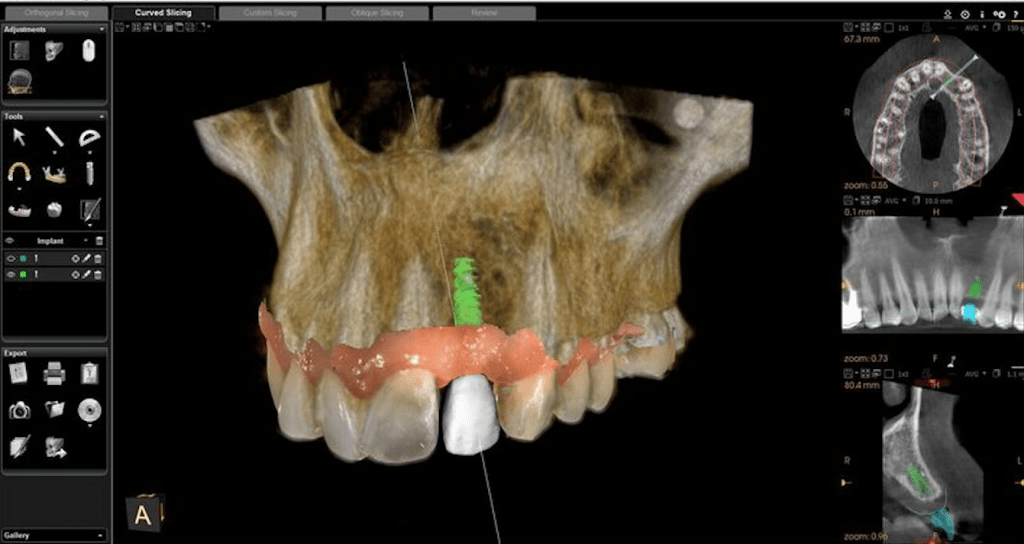 implantes dentales con tac 3d Palma Dentistas